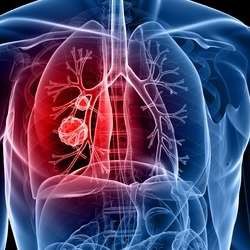 肺癌化療藥物