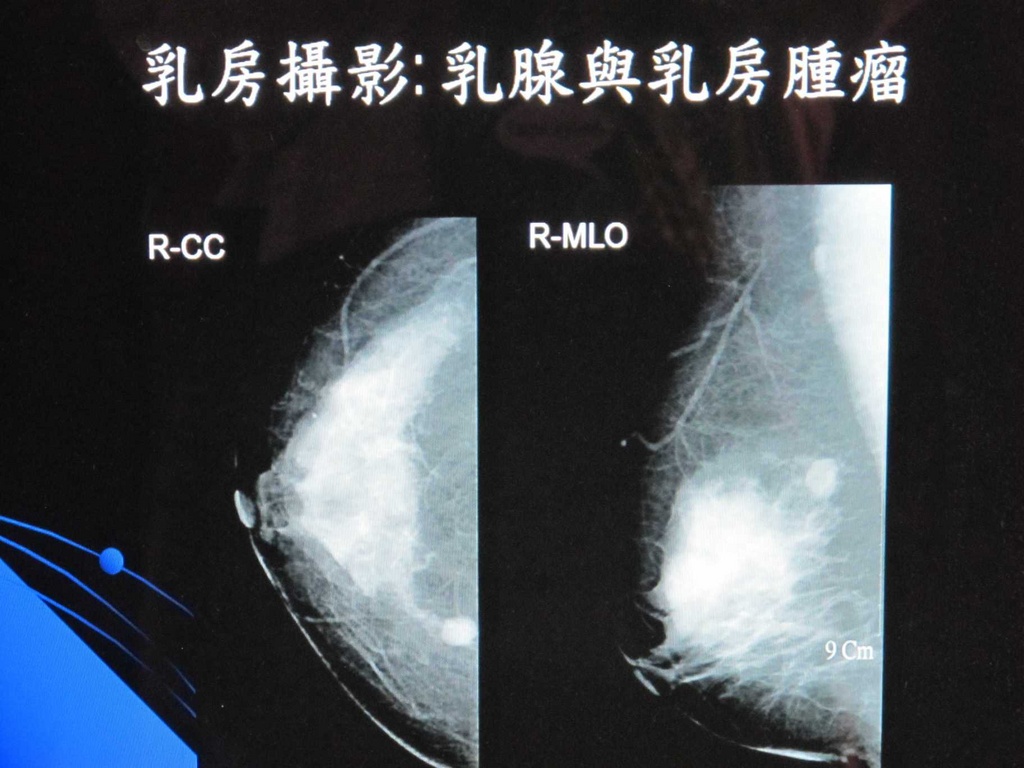 乳房超音波及乳房攝影是乳癌檢查利器＠coolanews府城電子報｜PChome 