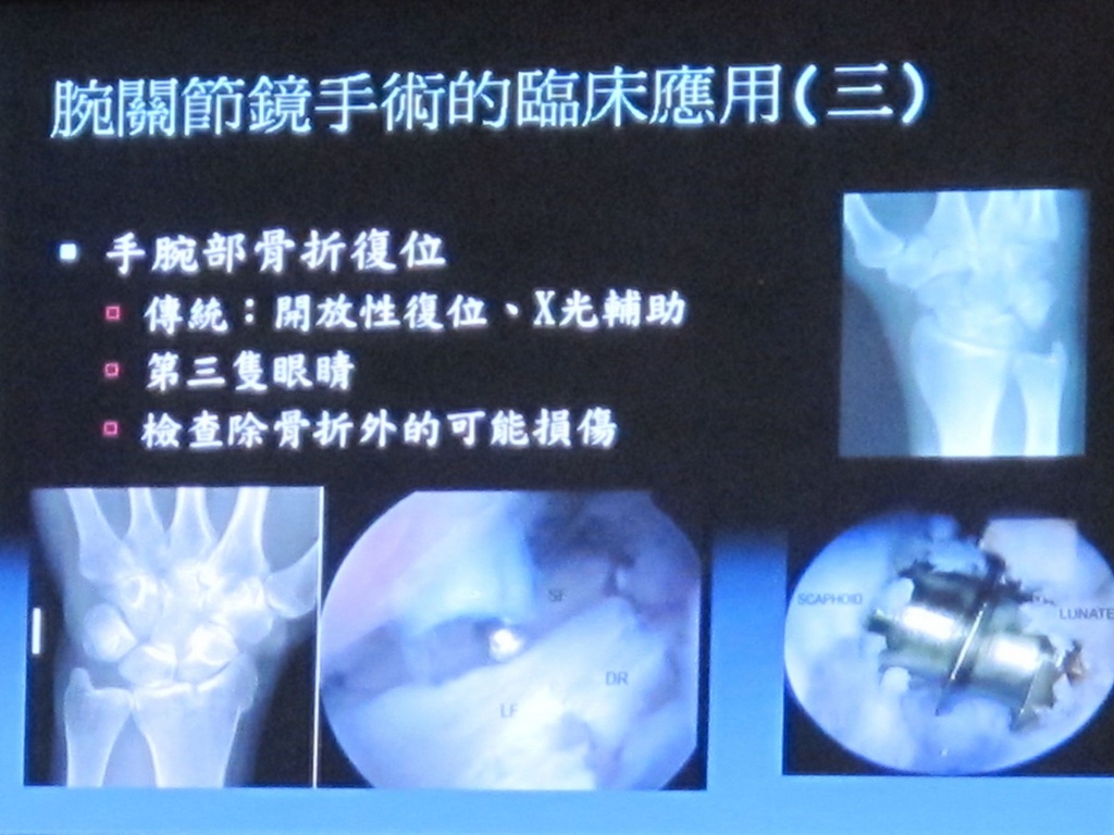 關節鏡微創手術應用於腕關節治療效果頗佳 Coolanews府城電子報 Pchome 個人新聞台