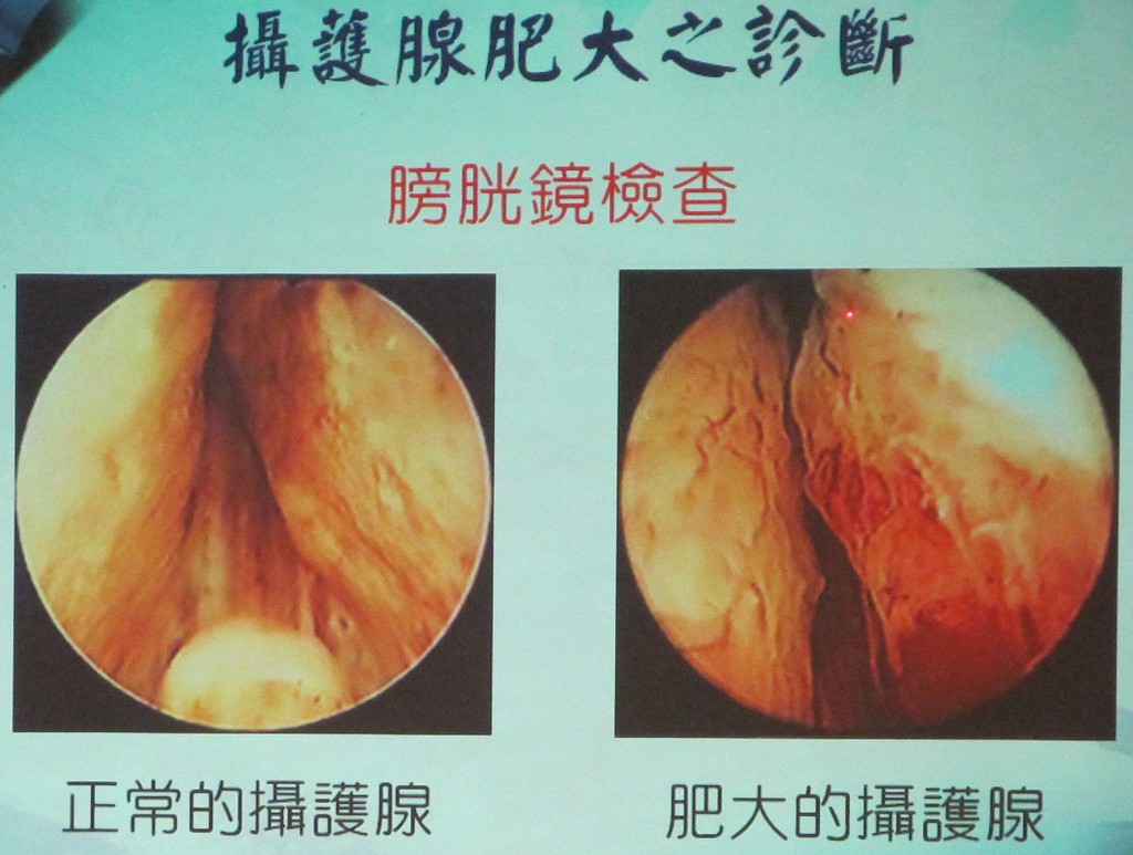 熟男生活的困擾 攝護腺肥大 Coolanews府城電子報 Pchome 個人新聞台