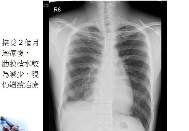 淺談少見的肋膜結核 Coolanews府城電子報 Pchome 個人新聞台