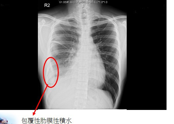 淺談少見的肋膜結核 Coolanews府城電子報 Pchome 個人新聞台